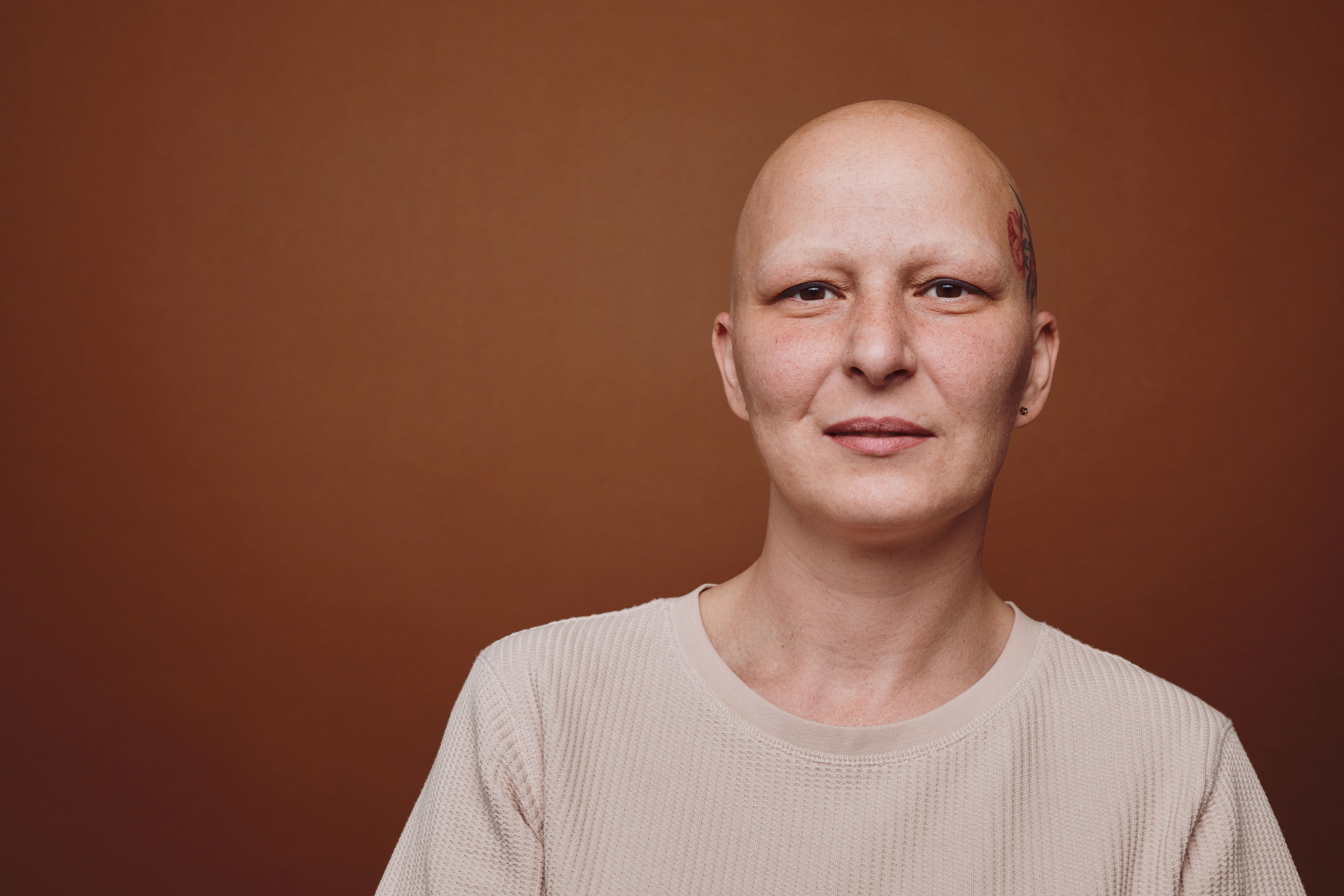 An analysis suggests a potential relationship between hypothyroidism and an increased risk for developing alopecia areata | image credit: Seventyfour - stock.adobe.com