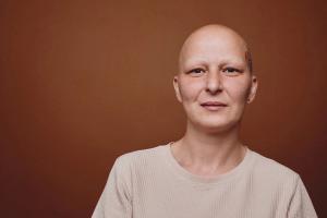 Bald woman alopecia cancer | Image credit: Seventyfour - stock.adobe.com