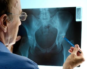 Study Finds Mortality Link Between Fractures, Multiple Myeloma