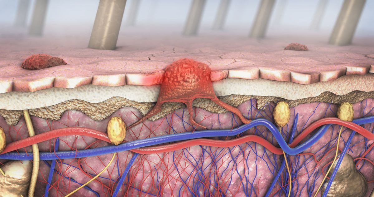 Image of skin cancer