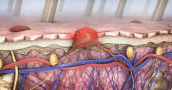 image of skin cancer