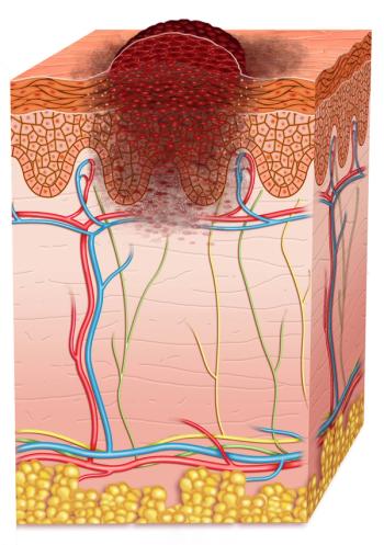 skin cancer graphic