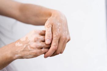 hands of a patient with vitiligo | Image Credit: Rabizo Anatolii - stock.adobe.com
