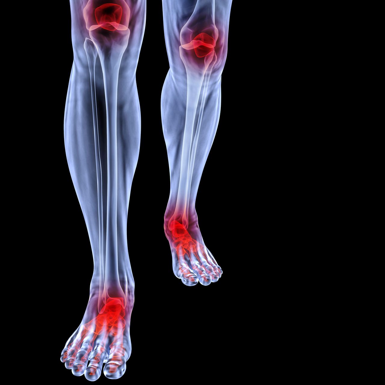 Development of PsA Linked to Tenosynovitis in Patients With Arthralgia