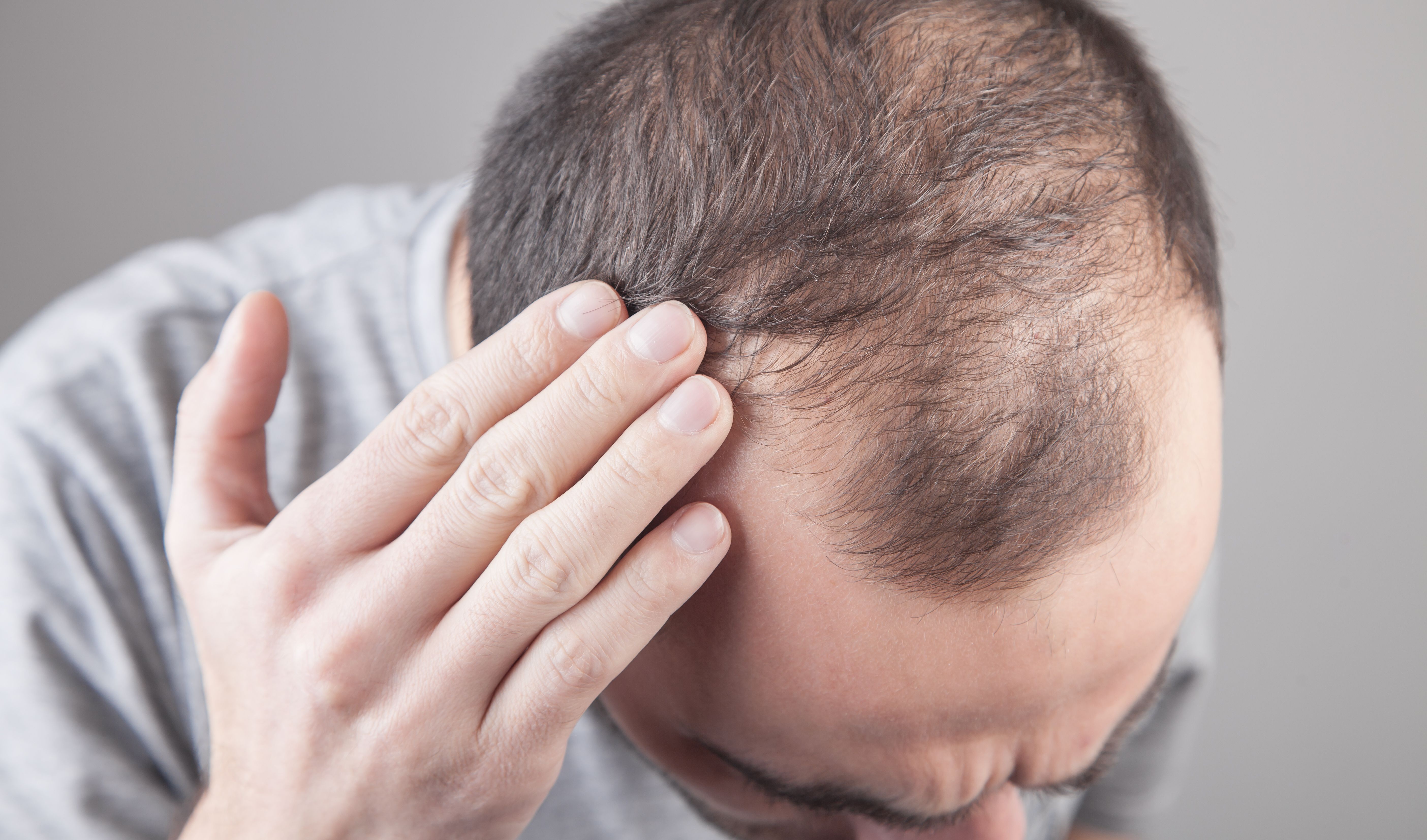 Androgenetic alopecia | Image Credit:  andranik123 - stock.adobe.com