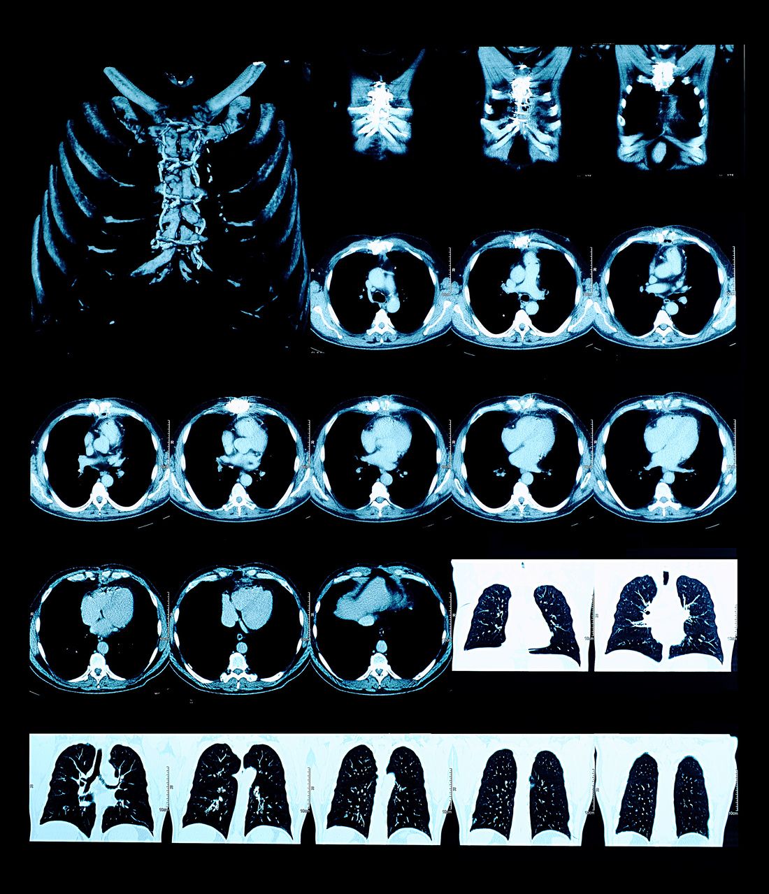 Researchers Describe Possibilities for Improving Lung Cancer Screening in Smokers