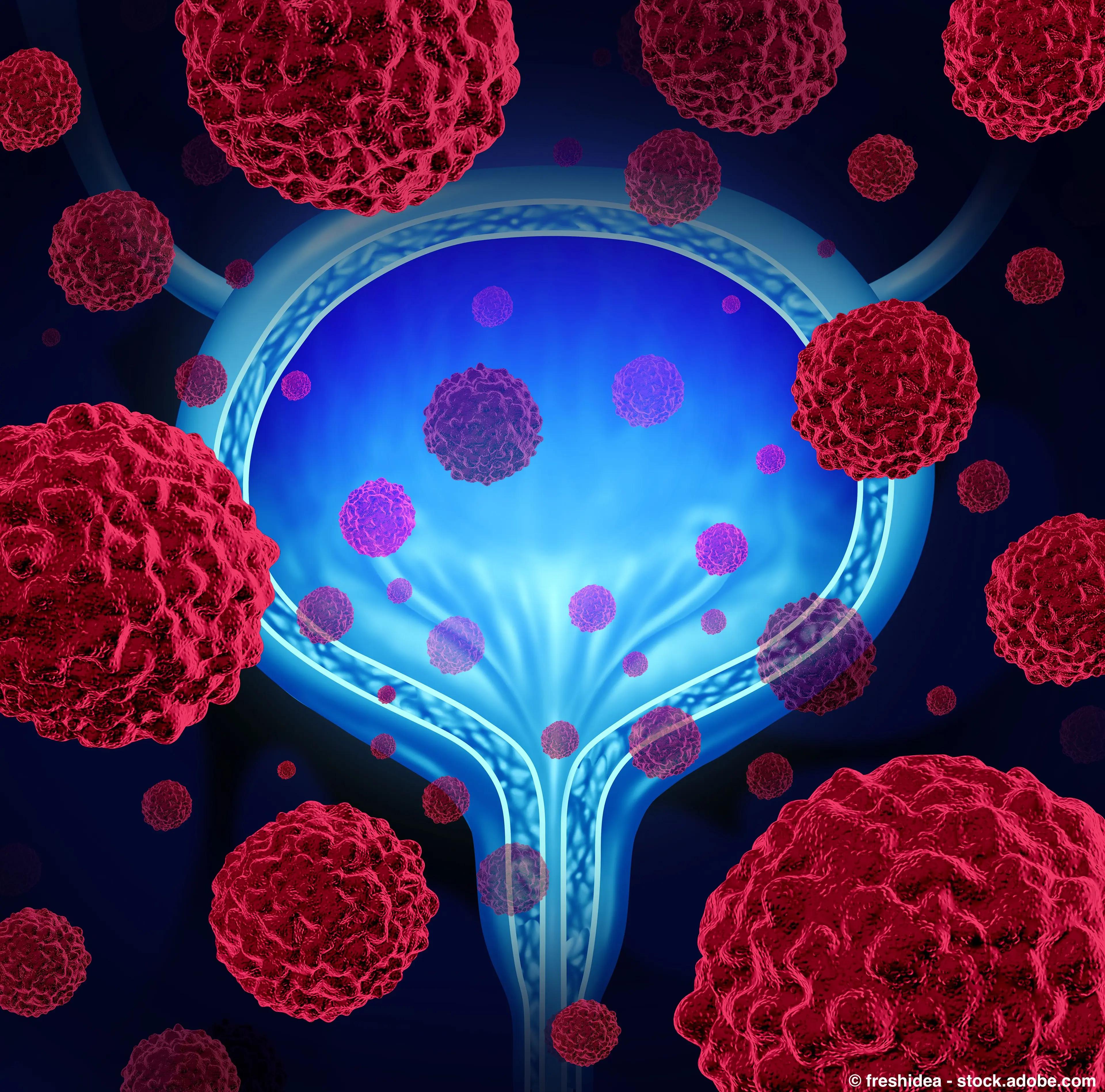 Bladder Cancer | freshidea @ adobe.com