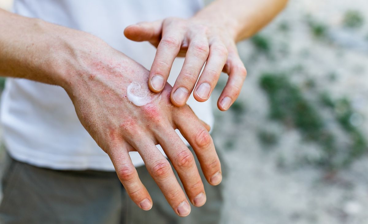 Chronic Hand Eczema Guidance Highlights Diagnostic Gaps, Emerging Therapies