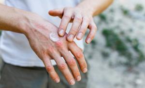 hand eczema | Image credit: Ольга Тернавская - stock.adobe.com
