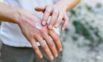 hand eczema | Image credit: Ольга Тернавская - stock.adobe.com