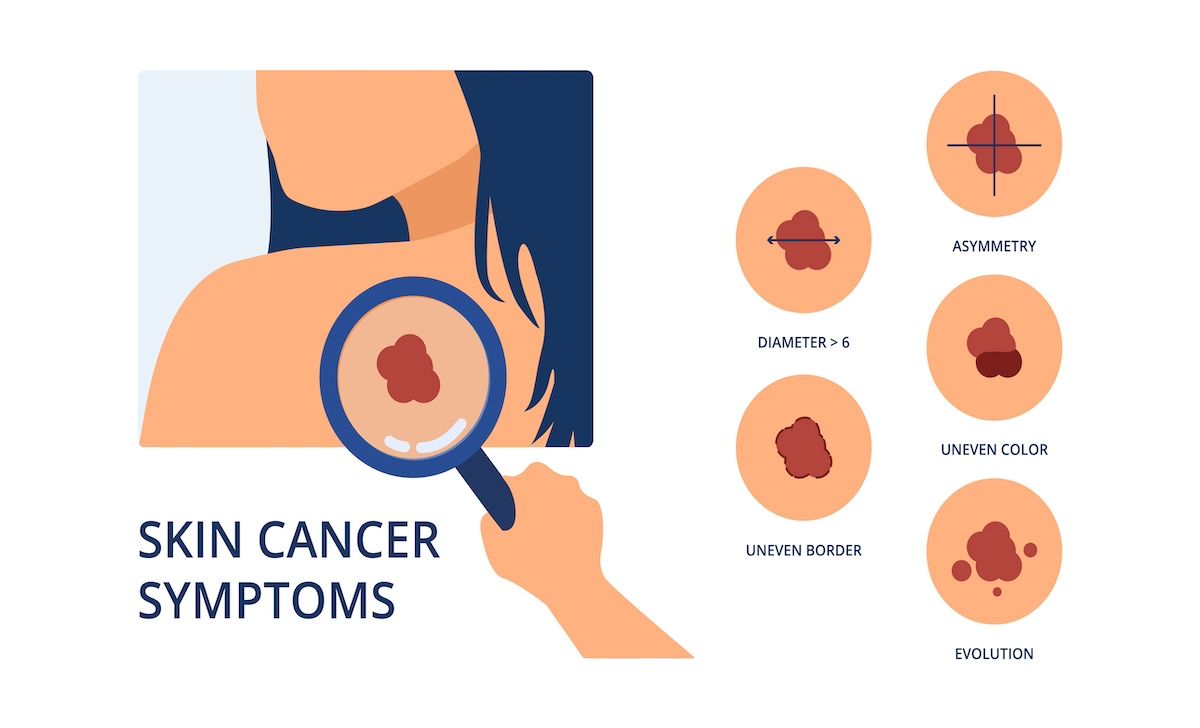 skin cancer | Image Credit: uffoow-stock.adobe.com