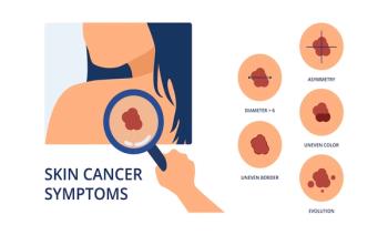 skin cancer | Image Credit: uffoow-stock.adobe.com