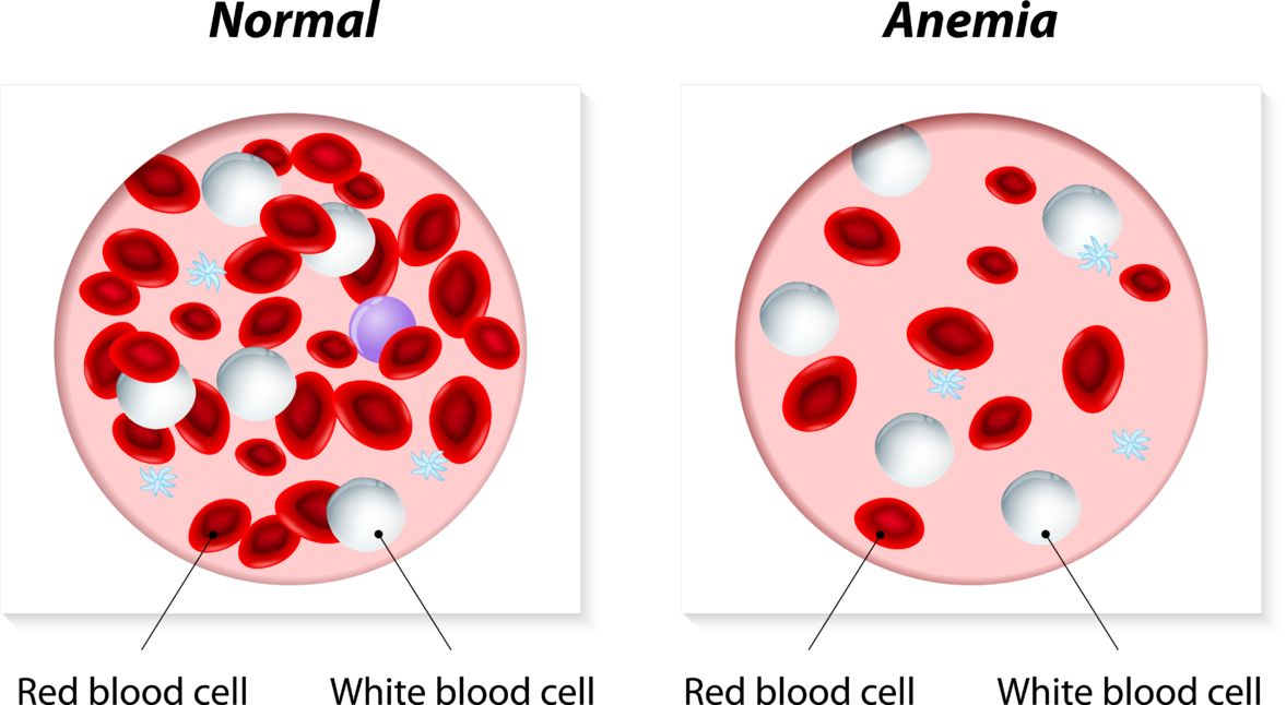 Acute Heart Failure, Hemoglobin Decrease Associated With Worse Outcome in Recent Study