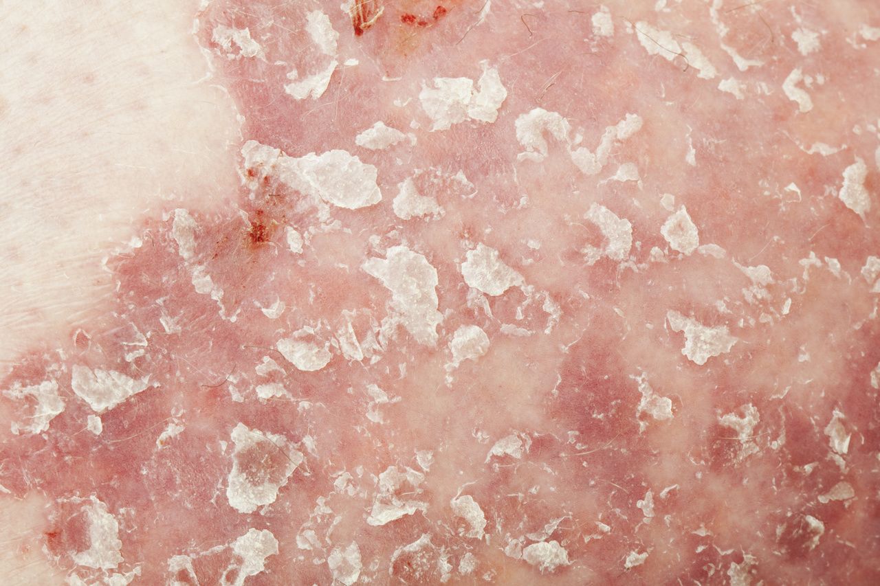 Defective Stem Cell Behavior Linked to Psoriasis