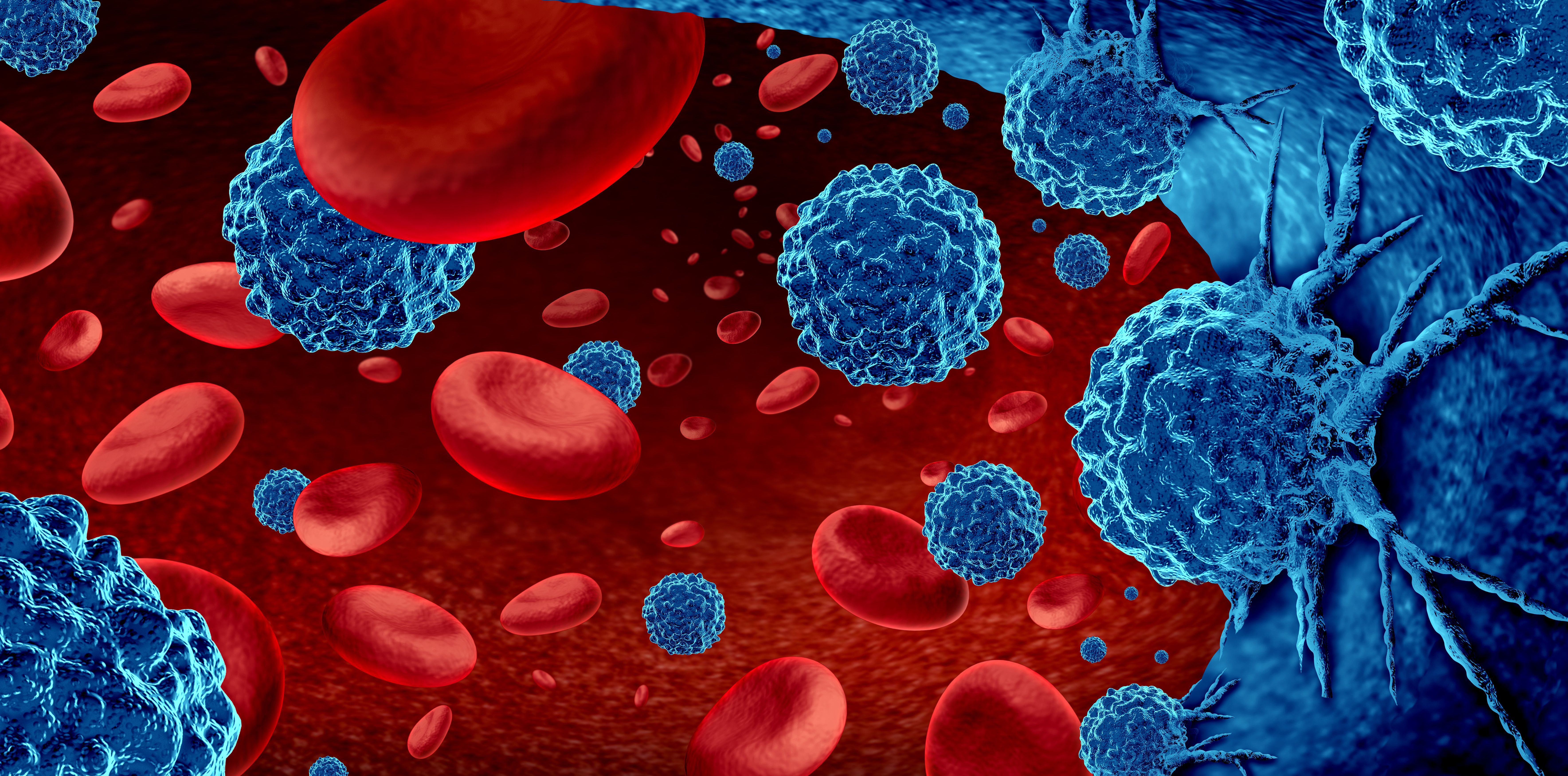 Cancer in the blood outbreak and treatment for malignant cells in a human body caused by carcinogens and genetics with a cancerous cell as an immunotherapy and leukemia or lymphoma symbol and medical | Image Credit: © freshidea - stock.adobe.com