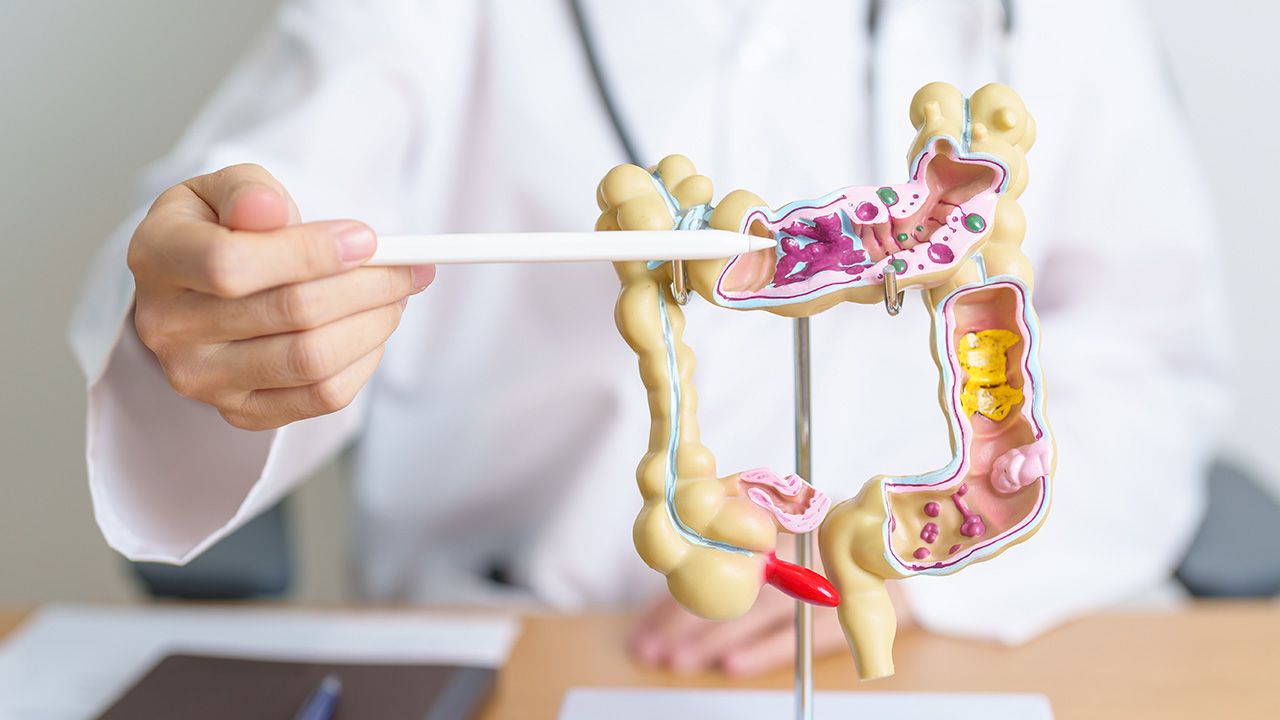 Doctor with human Colon anatomy model. Colonic disease, Large Intestine, Colorectal cancer, Ulcerative colitis, Diverticulitis, Irritable bowel syndrome, Digestive system and Health concept | Image credit: © Jo Panuwat D - © Jo Panuwat D - stock.adobe.com