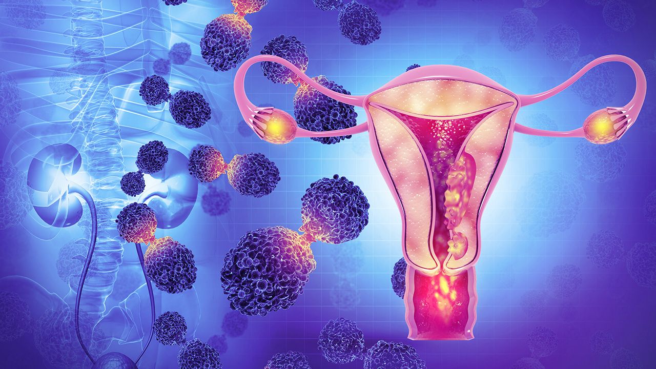 Female reproductive system diseases. Uterus cancer and endometrial malignant tumor as a uterine medical concept. 3d illustration | Image credit: © Crystal light - stock.adobe.com