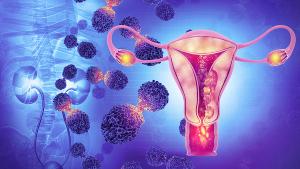 Female reproductive system diseases. Uterus cancer and endometrial malignant tumor as a uterine medical concept. 3d illustration | Image credit: © Crystal light - stock.adobe.com