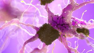 3D medical illustration of amyloid plaques on nerve cell representing Alzheimer's disease pathology and pepinemab SEMA4D antibody neuroinflammation mechanism| Image Credit: © Sebastian Kaulitzki - stock.adobe.com