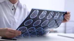 Doctor examining MRI images of patient with multiple sclerosis at table in clinic, closeup | Image credit: © New Africa - © New Africa - stock.adobe.com