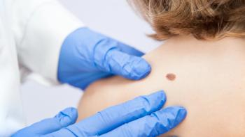 birthmark / A medical consultation at the Removal of nevus. | Image credit: © Damian Gretka - © Damian Gretka - stock.adobe.com