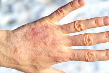Close-up of the back of a hand with dry, cracked, red patches of skin across the knuckles and wrist, against a blurred white background. | Image Credit: © Voyagerix - stock.adobe.com
