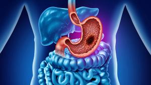 Gastric Cancer or stomach tumor in the digestive system as a medical and gastrointestinal disease with painful belly symptoms as a medicine concept. | Image credit: © freshidea - © freshidea - stock.adobe.com