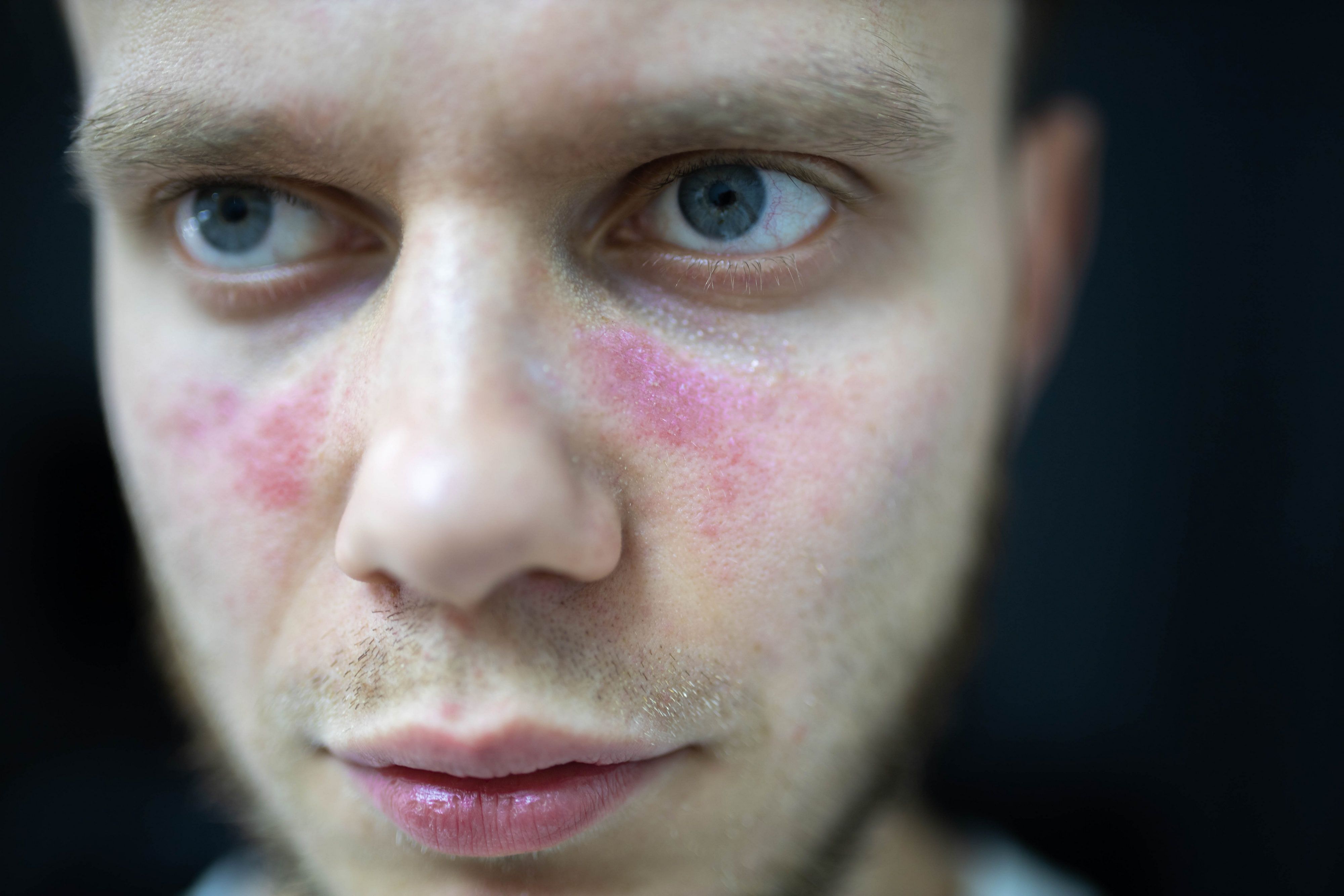 Close-up of a person's face with patchy red rash on the cheek, around the nose, and near the mouth. | Image Credit: © velimir - stock.adobe.com