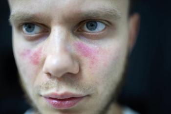 Close-up of a person's face with patchy red rash on the cheek, around the nose, and near the mouth. | Image Credit: © velimir - stock.adobe.com
