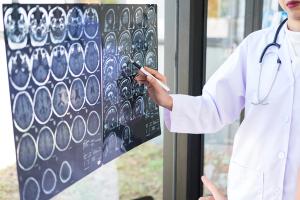 Brain scan imaging used in the diagnosis and monitoring of Alzheimer's disease. | Image Credit: © Freedomz - stock.adobe.com