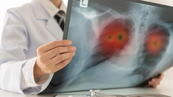 radiology x-ray lung cancer | Image credit: © utah51 - © utah51 - stock.adobe.com