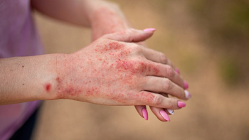 Close up dermatitis on skin, ill allergic rash eczema skin of patient , atopic dermatitis symptom skin detail texture , Fungus of skin ,The concept dermatology, treatment fungal | Image credit: © InfiniteStudio - © InfiniteStudio - stock.adobe.com