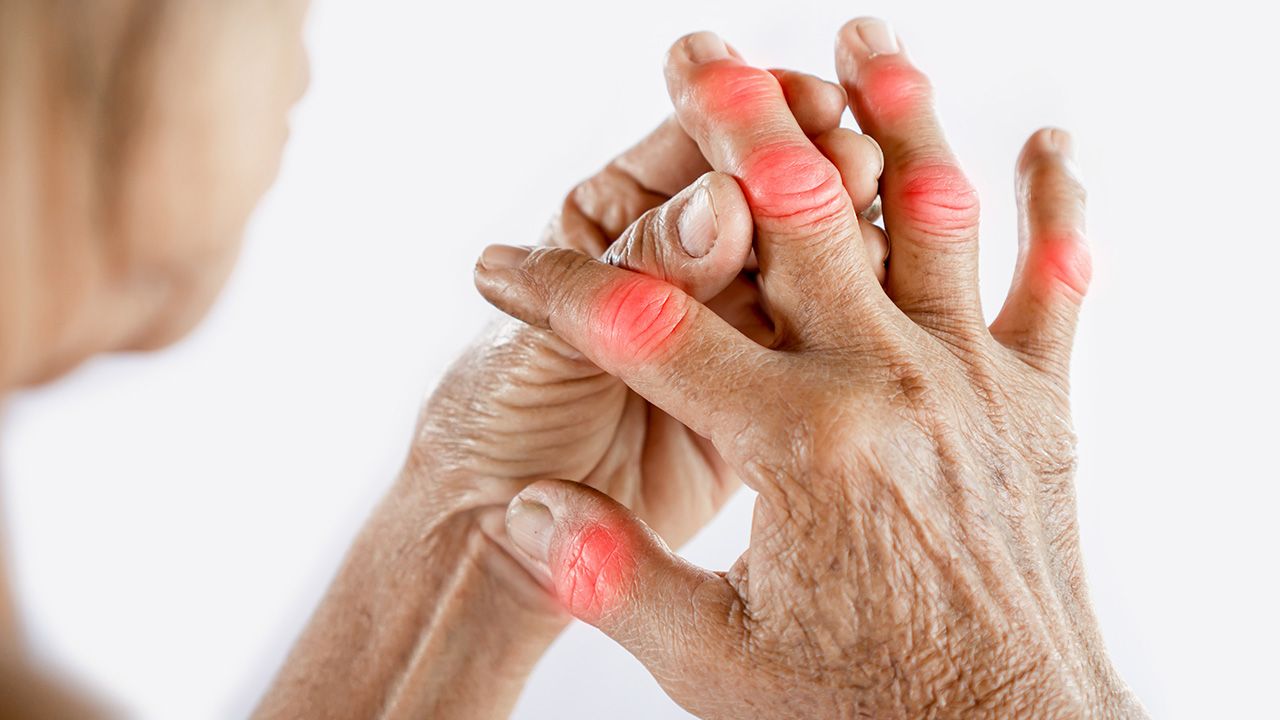 Asian woman hand suffering from joint pain with gout in finger | Image credit: © doucefleur - © doucefleur - stock.adobe.com