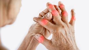 Asian woman hand suffering from joint pain with gout in finger | Image credit: © doucefleur - © doucefleur - stock.adobe.com
