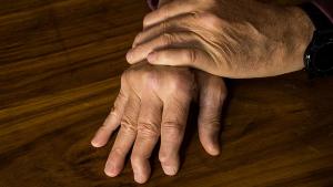 The hands of a male with Psoriatic Arthritis showing deviation of the Ulnar metacarpal joints. | Image credit: © Jacques Hugo - © Jacques Hugo - stock.adobe.com