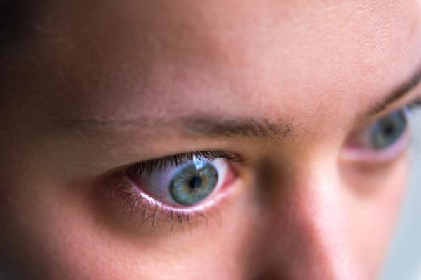 Patient with thyroid eye disease symptoms including proptosis and eye bulging. | Image Credit: © Andriy Blokhin - stock.adobe.com