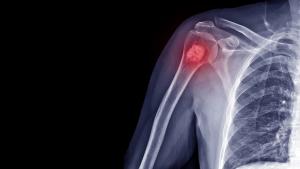 Film X-ray shoulder radiograph show Enchondroma disease at arm bone. Enchondrama is a benign tumor of cartilage grow within bone and expand it. Highlight on mass lesion. Medical oncology concept | Image credit: © Joel bubble ben - © Joel bubble ben - stock.adobe.com