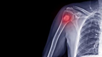 Film X-ray shoulder radiograph show Enchondroma disease at arm bone. Enchondrama is a benign tumor of cartilage grow within bone and expand it. Highlight on mass lesion. Medical oncology concept | Image credit: © Joel bubble ben - © Joel bubble ben - stock.adobe.com