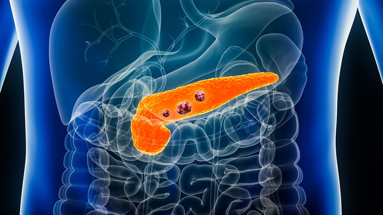 Pancreas or pancreatic cancer with organs and tumors or cancerous cells 3D rendering illustration with male body. Anatomy, oncology, disease, medical, biology, science, healthcare concepts. | Image credit: © Matthieu - © Matthieu - stock.adobe.com  
