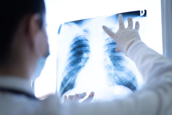 A healthcare provider wearing gloves examines a chest X-ray displayed on a lightbox. | Image Credit: © as-artmedia - stock.adobe.com 
