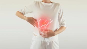 Medical illustration of an inflamed liver in a female patient, representing metabol ic dysfunction-associated steatohepatitis (MASH) and chronic liver disease. | Image Credit: © mi_viri -stock.adobe.com