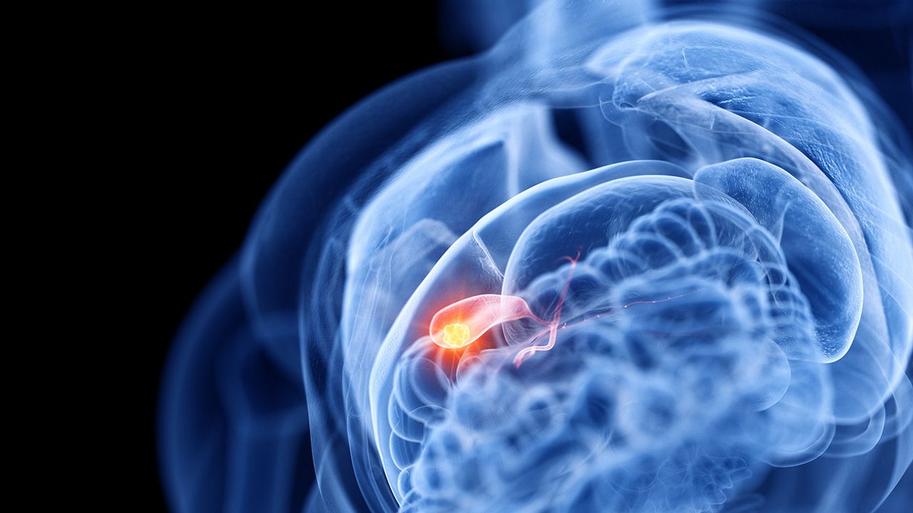 3d rendered medically accurate illustration of the gallbladder cancer | Image credit: © Sebastian Kaulitzki - © Sebastian Kaulitzki - stock.adobe.com 