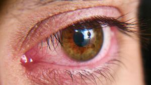 Red squirrel eyes, macro photo. Conjunctivitis, eye disease. | Image credit: © Kryuchka Yaroslav - © Kryuchka Yaroslav - stock.adobe.com