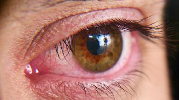 Red squirrel eyes, macro photo. Conjunctivitis, eye disease. | Image credit: © Kryuchka Yaroslav - © Kryuchka Yaroslav - stock.adobe.com