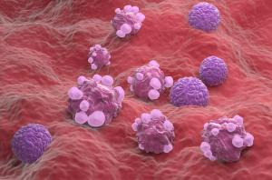 3D scientific illustration of ovarian cancer cells representing platinum-resistant ovarian cancer, the focus of an ongoing phase 1 study of CTIM-76. | Image Credit: © LASZLO - stock.adobe.com