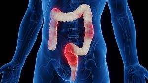 3D medical illustration of a man's inflamed colon | Image credit: © Sebastian Kaulitzki - © Sebastian Kaulitzki - stock.adobe.com