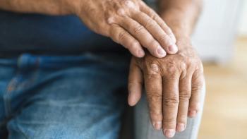 Elderly man suffering from psoriasis on hands | Image credit: © and.one - © and.one - stock.adobe.com