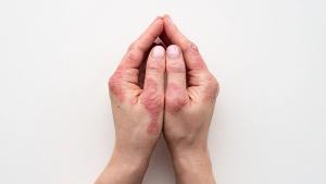 Psoriasis skin. Closeup of rash and scaling on the patient's skin. The concept of chronic disease treatment. Dermatological problems. Hard, horny and cracked skin in woman's hands. Dry skin. Isolated. | Image credit: © IIIRusya - © IIIRusya - stock.adobe.com