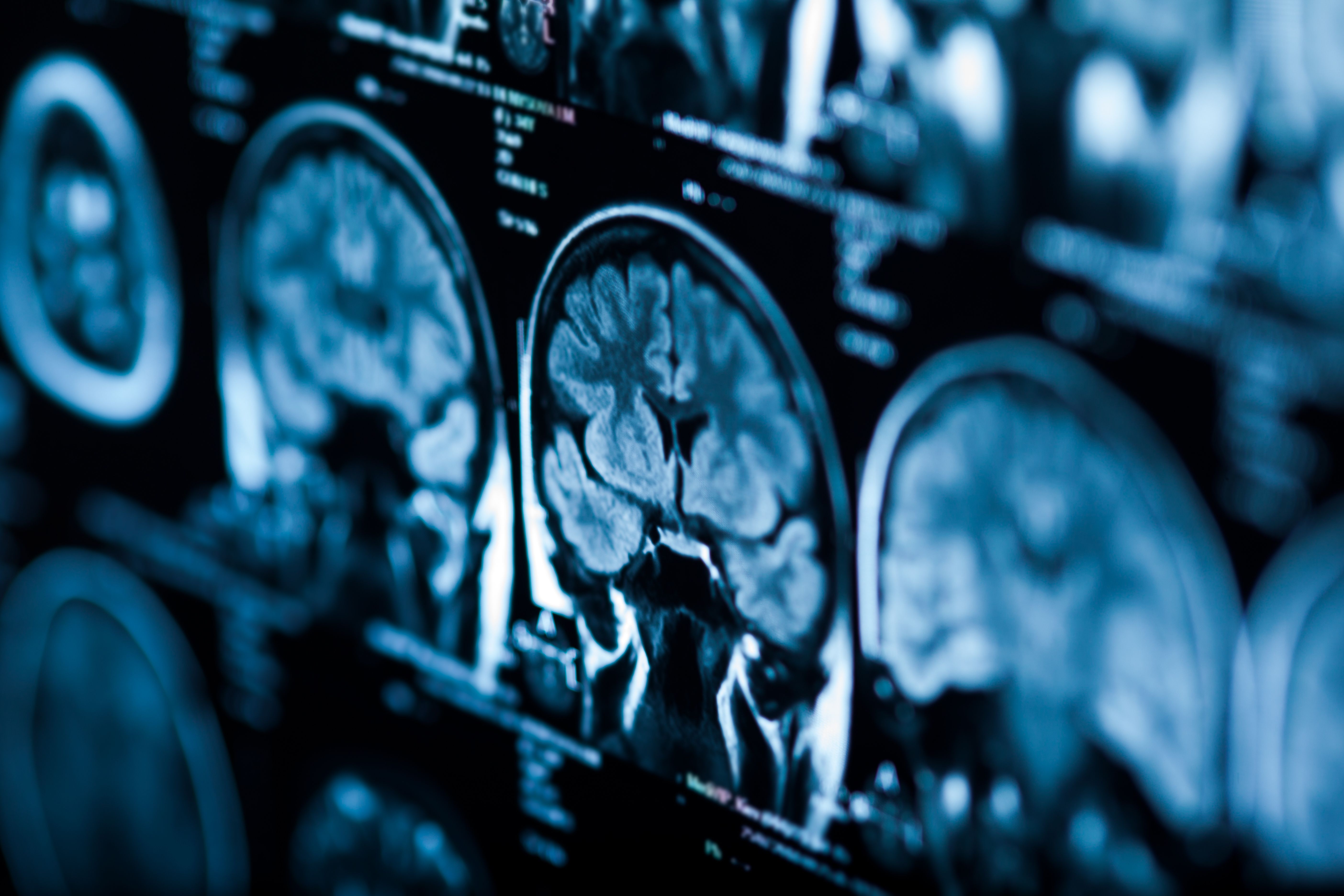 X-ray image of the human brain. | Image Credit: © merydolla - stock.adobe.com