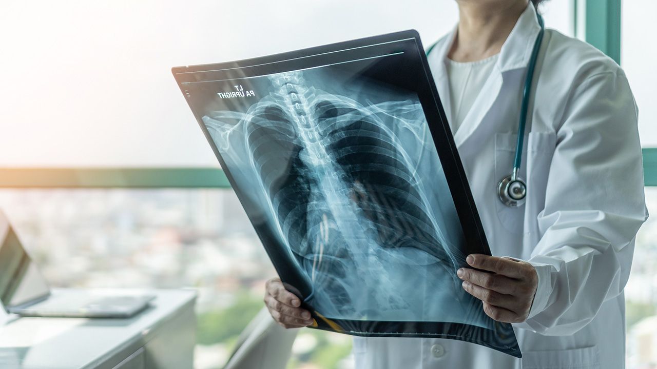 Doctor diagnosing patient’s health on asthma, lung disease, COVID-19 or bone cancer illness with radiological chest x-ray film for medical healthcare hospital service | Image credit: © Chinnapong - © Chinnapong - stock.adobe.com